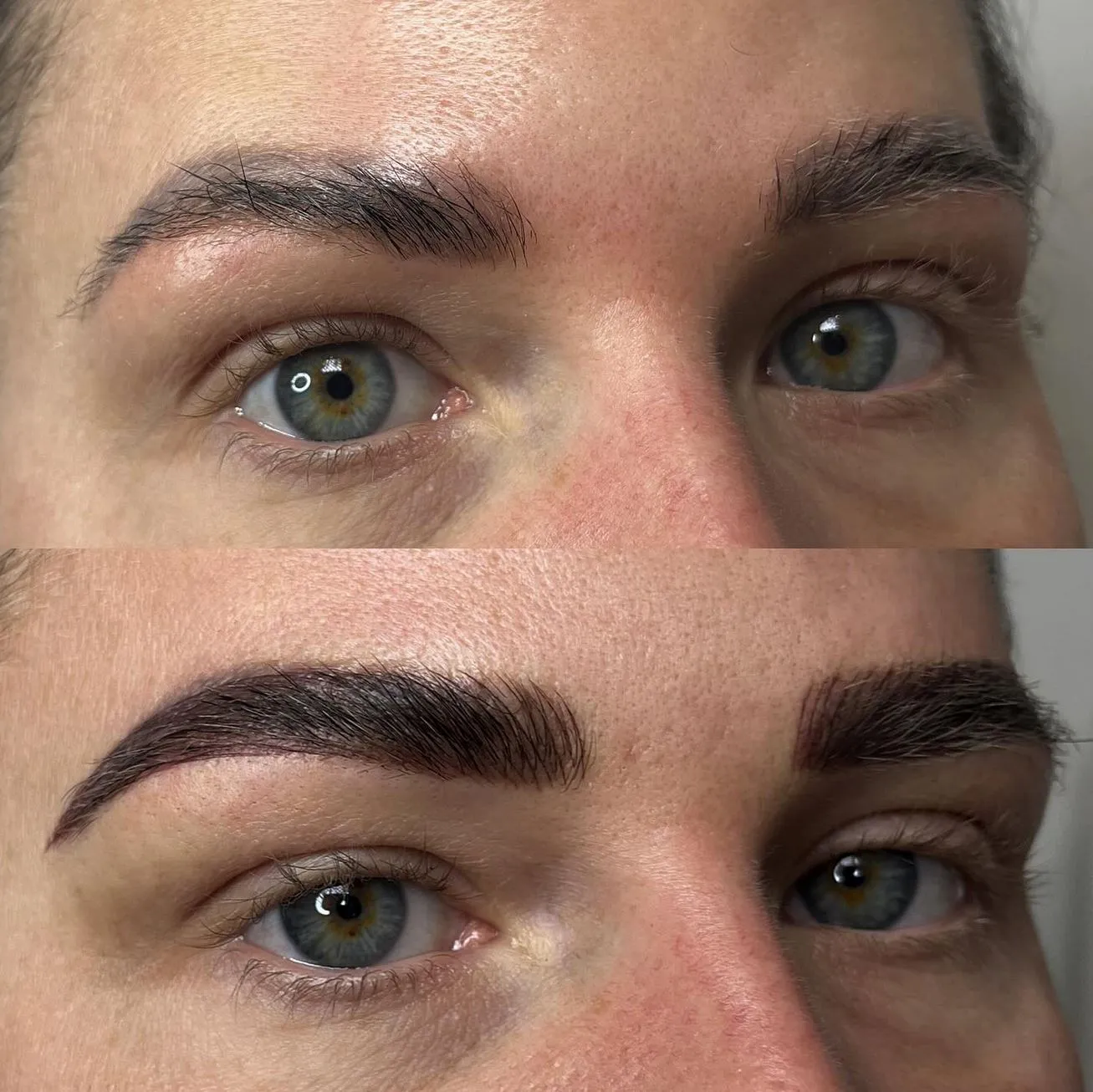 Can Saline Tattoo Removal Cause Scarring