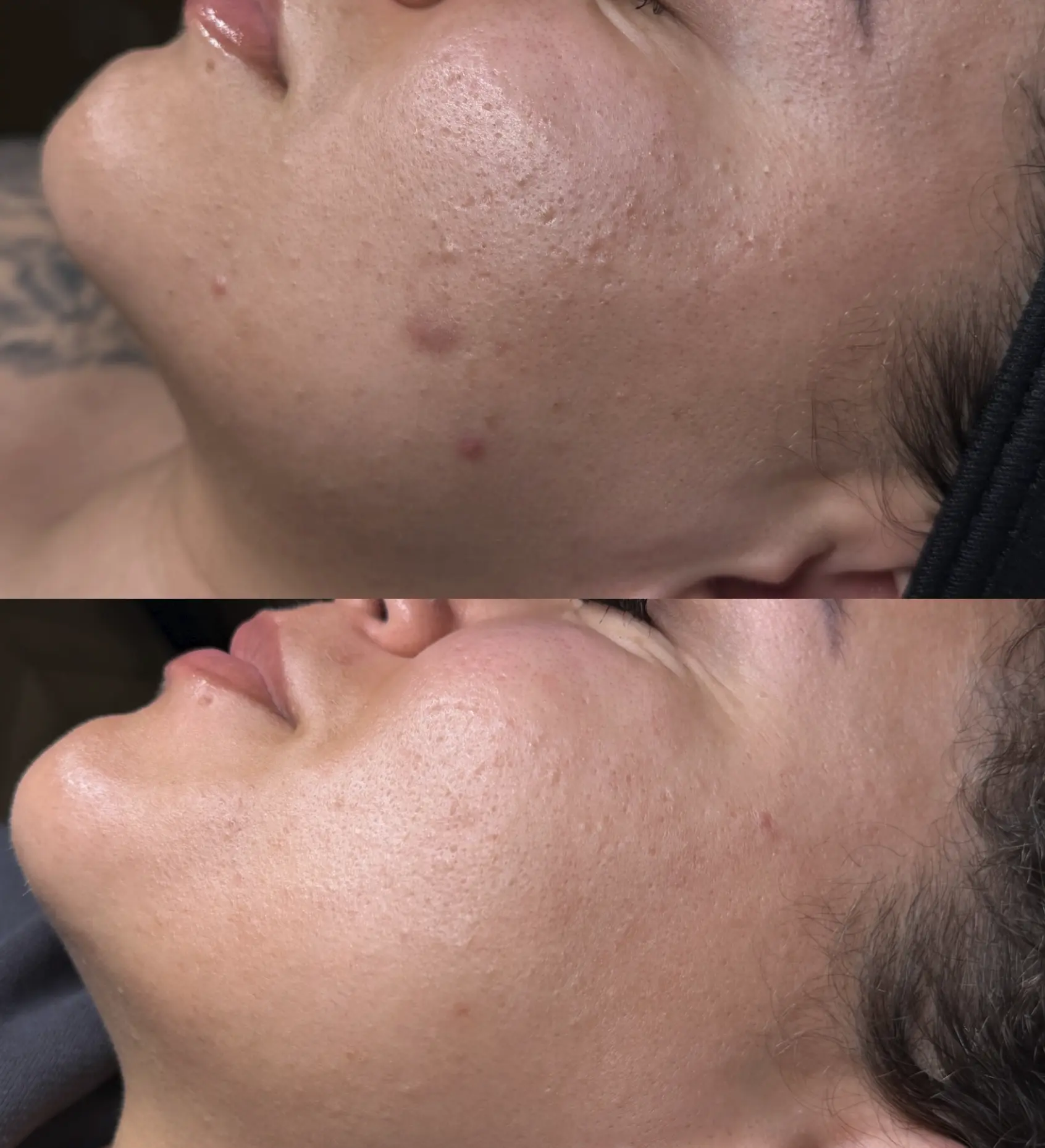 dermaplaning and microneedling course near me