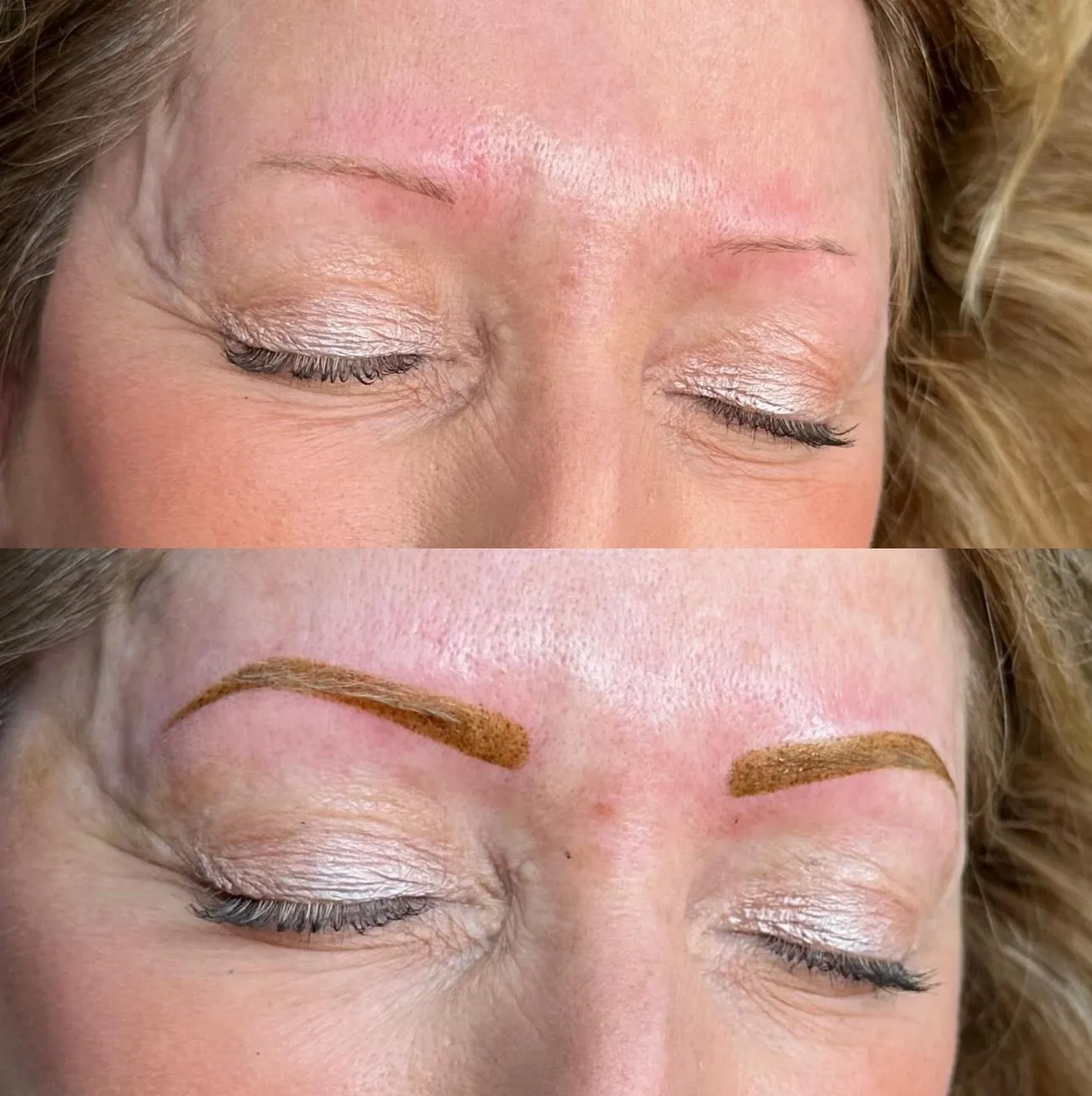 tattoo removal